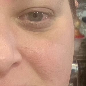 After Pureance: Reduced eye puffiness and dark circles